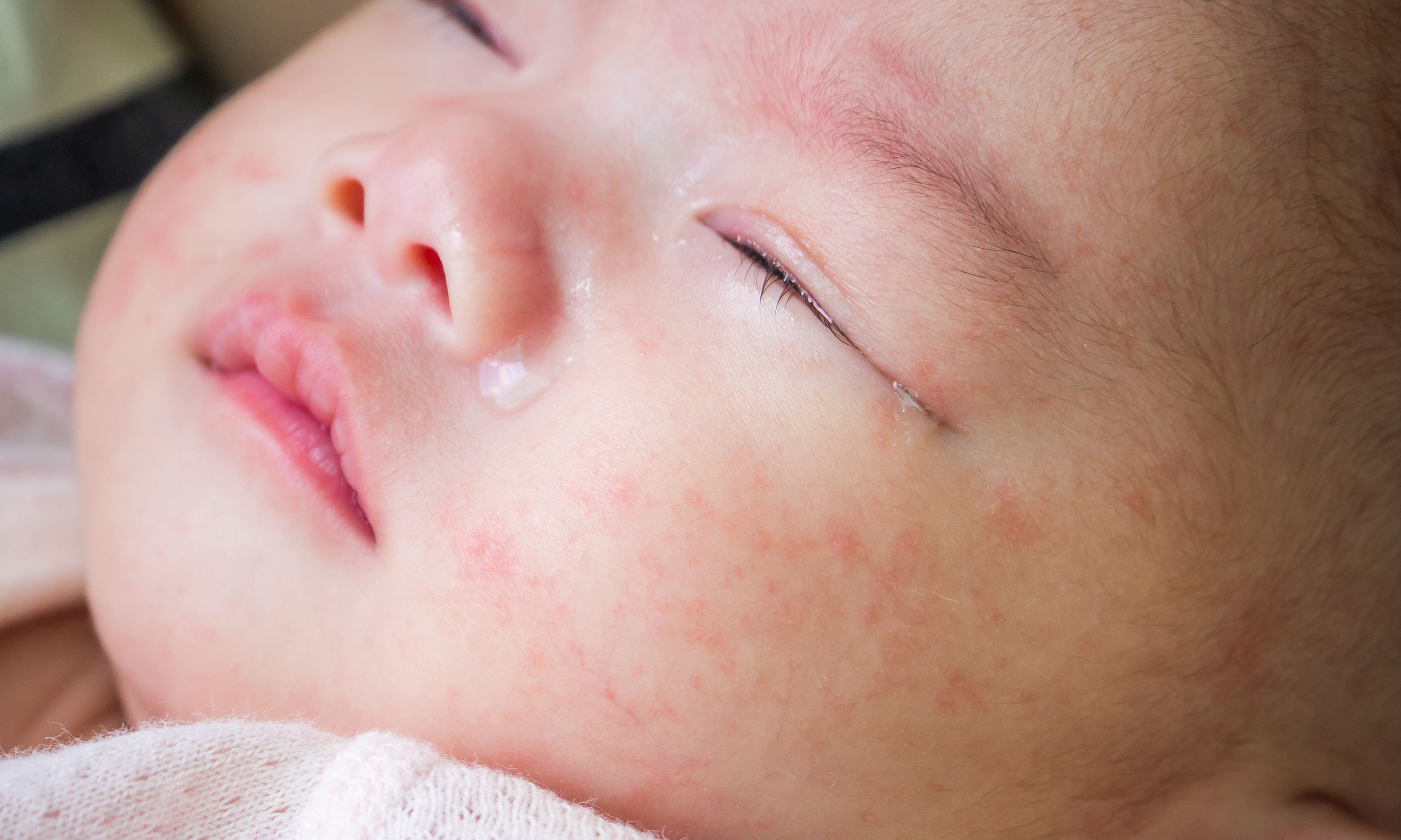 關(guān)于寶寶食物過(guò)敏，家長(zhǎng)要知道的4件事